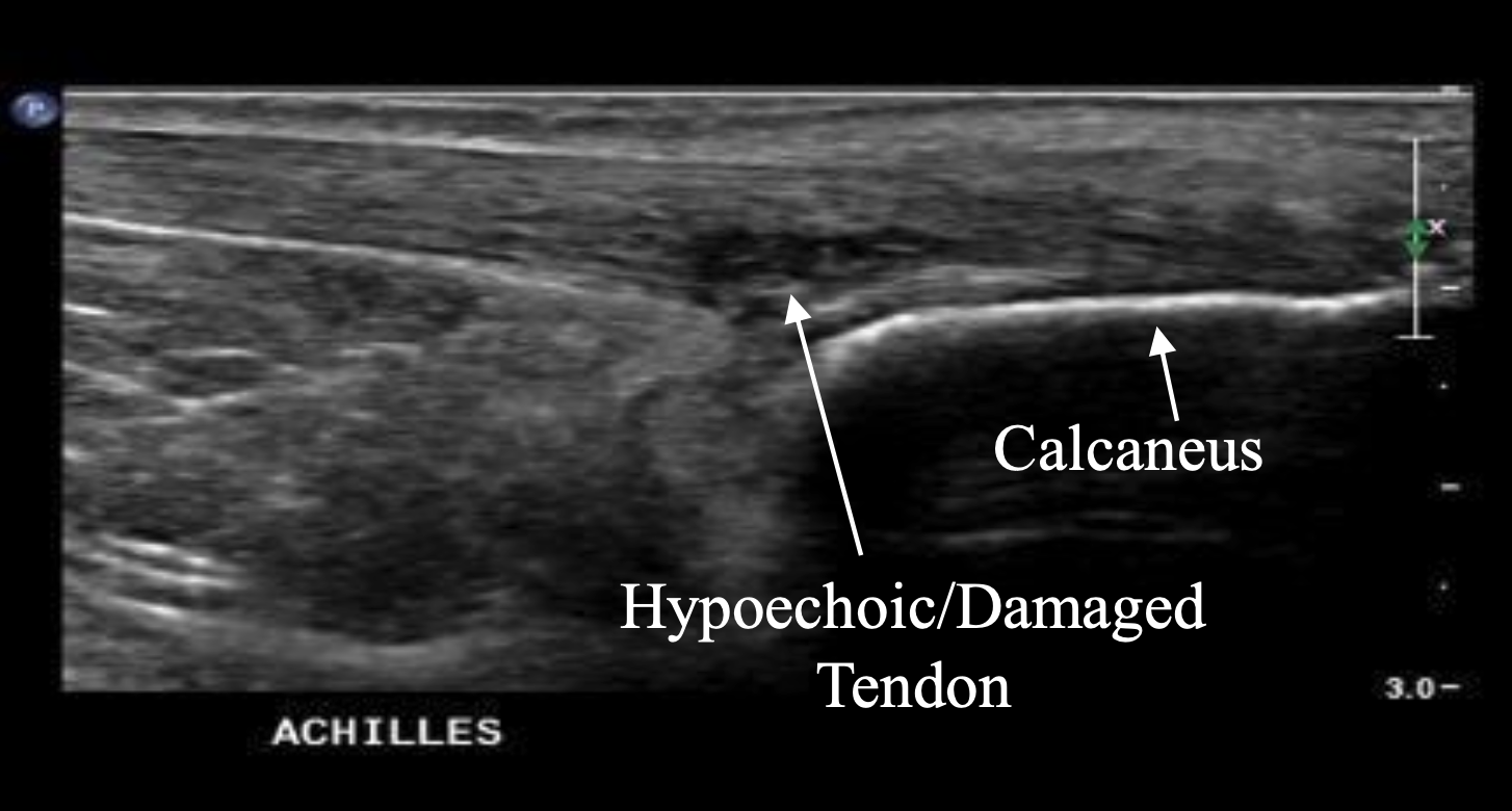 Damaged Achilles Tendon Ultrasound